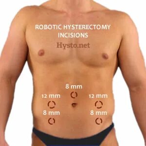 Laparoscopic Hysterectomy: Total Laparoscopic, Robotic, Vagi