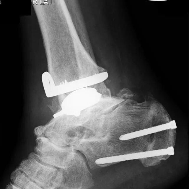 👁 Das Röntgenbild zeigt eine Sprunggelenksprothese nach Begradigung des Sp...