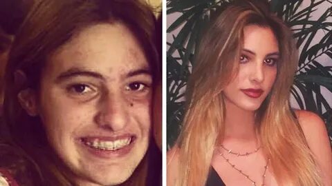10 YouTube Stars Before & After Plastic Surgery (TheGabbieSh