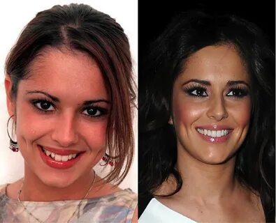 Celeb Teeth - Before and After - Xclusive Touch Celebrity te
