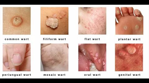 Warts on Skin - Types Causes and Home Remedies for Skin Wart