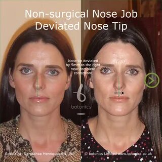 Non surgical nose job near me. 🔥 Non Surgical Nose Job Los A