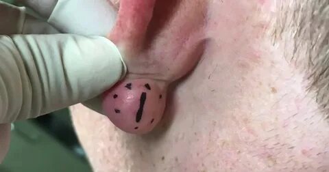 Watch Dr. Pimple Popper take on this guy's 'cute' earlobe cy
