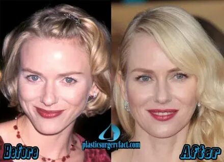 Naomi Watts Plastic Surgery Before and After - Plastic Surge