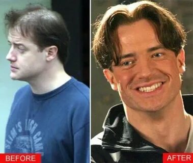 Did Brendan Fraser get a hair transplant? Hair transplant, M