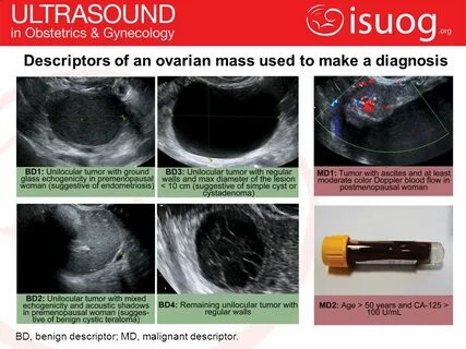 UOG Journal Club: January ppt video online download