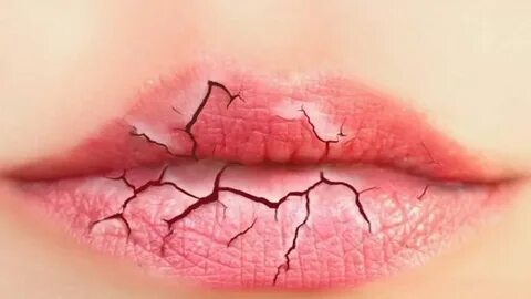 Chapped Lips - Causes, Prevention and Treatment To Get Rid &