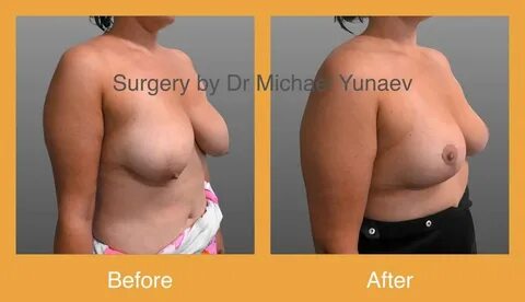 Boob lift without surgery