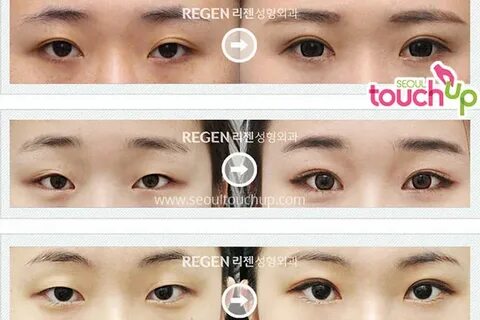 Eyelid Surgery in Korea Seoul TouchUp