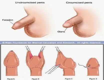 What’s better circumcised or uncircumcised - Ppvdc