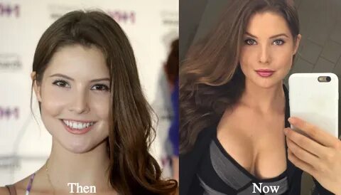 Amanda Cerny Lip Fillers before and after - Latest Plastic S