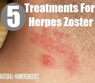 Herpes Zoster / Post Herpes Zoster Pain Treatment in Delhi O