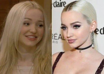 Dove Cameron Plastic Surgery Before and After - Celebrity Su