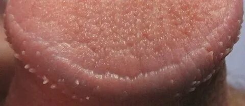 Pin on Pearly Penile Papules
