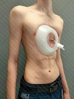 Buy Vacuum bell for PEctus excavatum with worldwide delivery