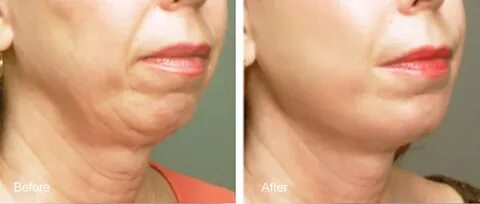 Fat Grafting Los Angeles Fat Transfer for Face and Body Cont