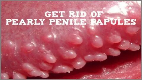 Pin on How To Get Rid Of Pearly Penile Papules In 3 days