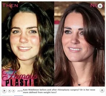 Kate Middleton Nose job, Rhinoplasty surgery, Nose plastic s