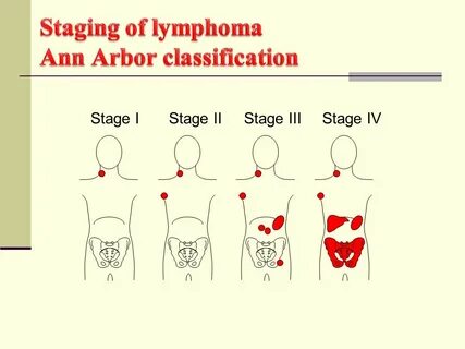 Lymphomas Ismail M. Siala. - ppt video online download