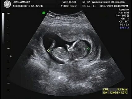 How To Tell Baby Gender From Ultrasound Picture 12 Weeks