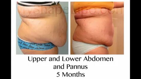 MyShape Lipo - Large Volume Liposuction to Abdomen - YouTube