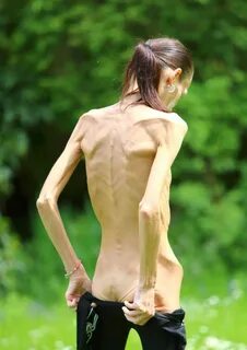 Anorexic Nude