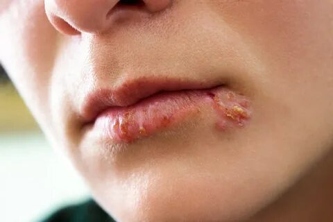Herpes im Mund - Auslöser und Behandlung - Heilpraxis