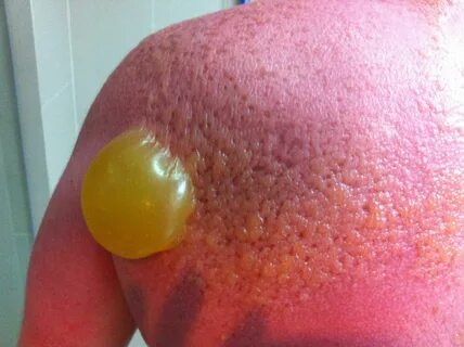 OMG the sworst sunburn ever. OMG I am only repinning this be