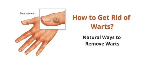 How to Get Rid of Warts in 10 Natural Ways Daily Health Cure