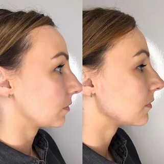 Nose Job in Cheshire - Dermal Fillers Botox Liposuction Skin