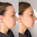 Professionally Completed Non Surgical Nose Job in Bowdon