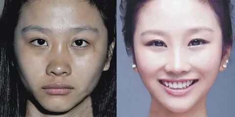 Korean Plastic Surgery Before After - Before and After Photo