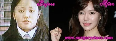 Kim Ah Joong Plastic Surgery Before & After Pics