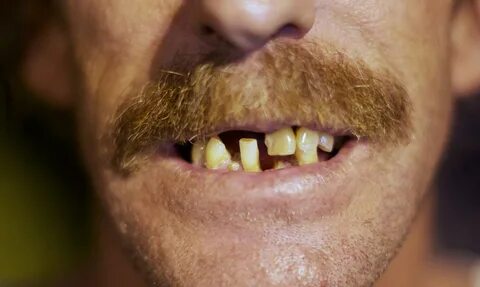 The Difference Between Rich and Poor? Eight Teeth, Says Dent