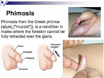 Phimosis from the Greek phimos (φῑμός "muzzle"