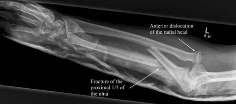 Monteggia fracture - subluxation of radial head, proximal ul