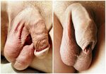 File:Circumcised and uncircumcised penis.jpg - Wikipedia