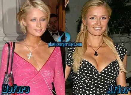 Paris Hilton Breast Implants: Fact or Rumor - Plastic Surger