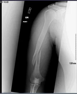 Humeral Shaft Fracture Orthobullets