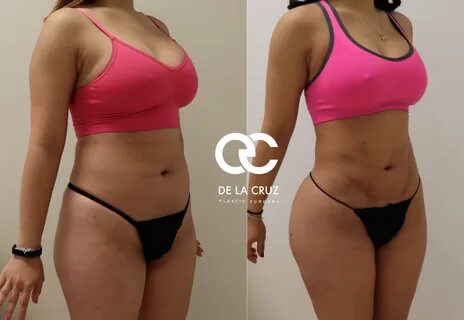 BEFORE AND AFTER LIPOSUCTION (FEMALE) 