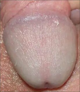 Single pearly penile papule on the glans penis. Diagnosis is