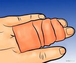 Як лікувати зламаний палець