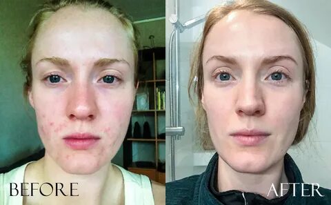 BEFORE & AFTER photos: Irritated sensitive troubled skin & a