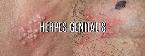 Herpes Genitalis - Pengobatan Tradisional Ny. Djamilah Najmu