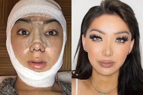 My Facial Plastic Surgery Story - Otlwb