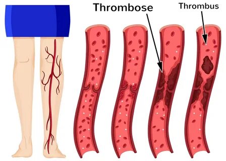 Risiko Phlebothrombose - tiefe (Bein-)Venenthrombose (TVT)