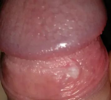 red white bump on penis - Bumps Around the Head of a Penis