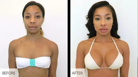 Breast Implant (Augmentation) Surgery Procedure.