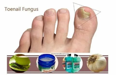 Toe Fungus Cure - NewelHome.com