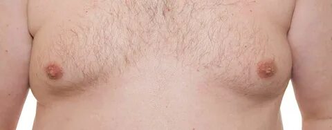 close up of a man's chest with gynecomastia.